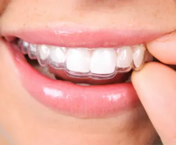 aparelho ortodontico invisivel