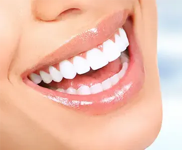 Ilustração de facetas dentárias