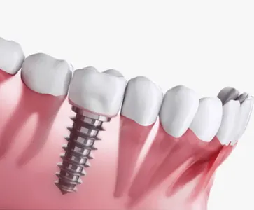 Ilustração de implante dentário